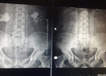 Böbreklerinden çıkan 500 taş doktoru bile şaşırttı