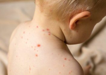 Dünyada kızamık vakaları dört kat arttı