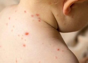 ‘Kızamık ve çocuk felci vakaları yükselişte’