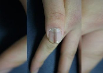 Tırnaklardaki koyu renk çizgiler hastalık habercisi