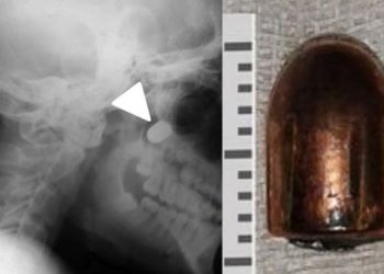 Ukraynalı çocuğun mucize kurtuluşu… Mermi, omurgasını sıyırıp geçti