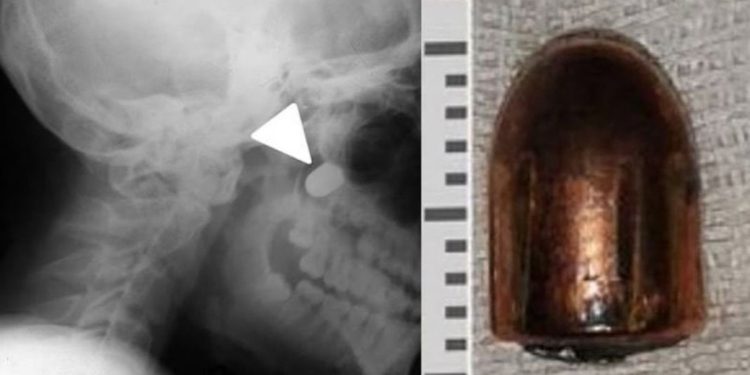 Ukraynalı çocuğun mucize kurtuluşu… Mermi, omurgasını sıyırıp geçti