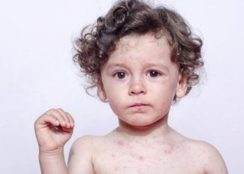 UNICEF: Kızamık vakaları yılın ilk 3 ayında yüzde 300 arttı