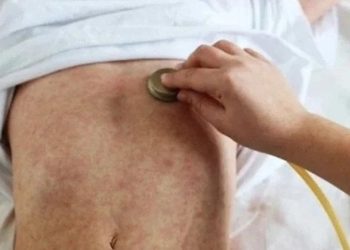 ‘Kızamık bir önceki altı aya kıyasla çok yüksek’