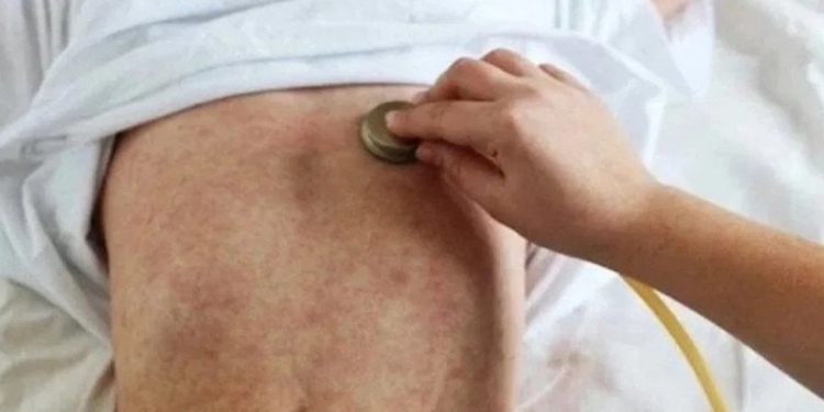‘Kızamık bir önceki altı aya kıyasla çok yüksek’