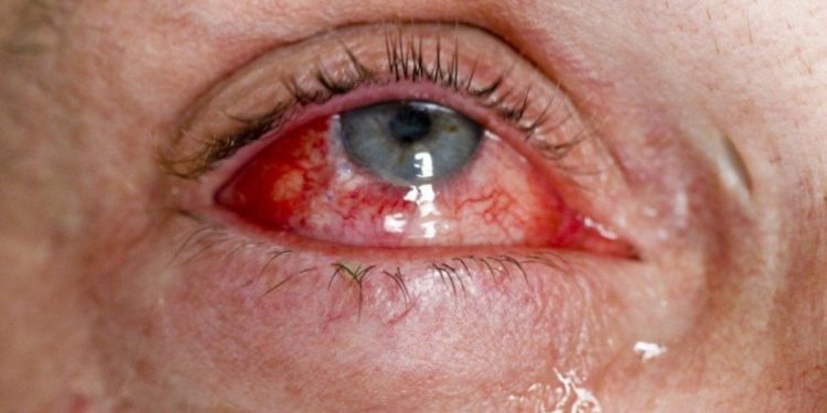 Bulaşıcı ‘kırmızı göz’ hastalığı hızla yayılıyor: Sayı 86 bini geçti